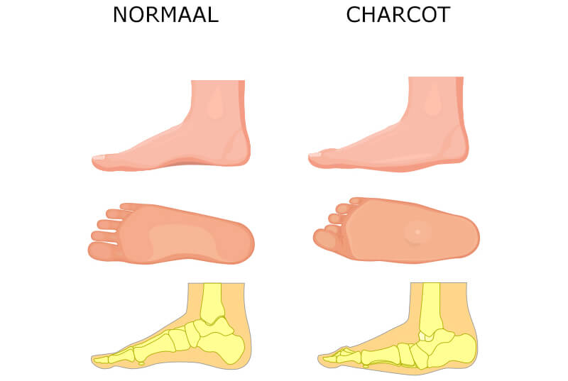 Charcot voet Charcot voet