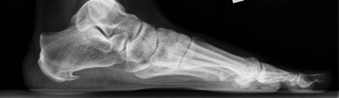 Hielspoor op röntgenfoto Hielspoor op röntgenfoto