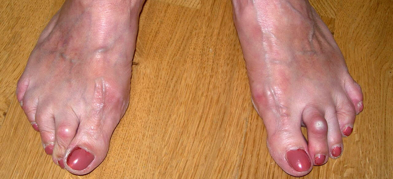 Hamertenen en klauwtenen Hamertenen en klauwtenen