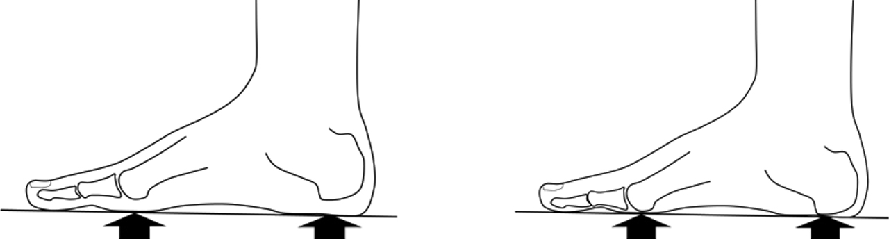 Schade aan de (vet) kussentjes onder de voorvoet Schade aan de (vet) kussentjes onder de voorvoet