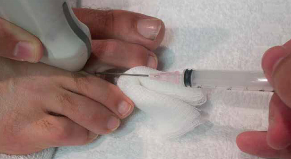 Degeneratie vetkamersysteem en andere vetproblemen Degeneratie vetkamersysteem en andere vetproblemen